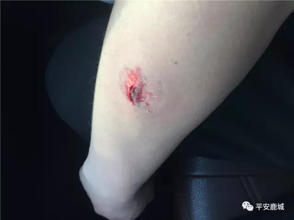 贵州一毒贩拒捕咬伤民警，押解途中称自己患有艾滋病